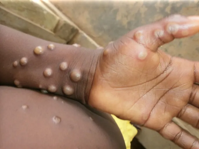 WHO: Mpox Bukan COVID Baru