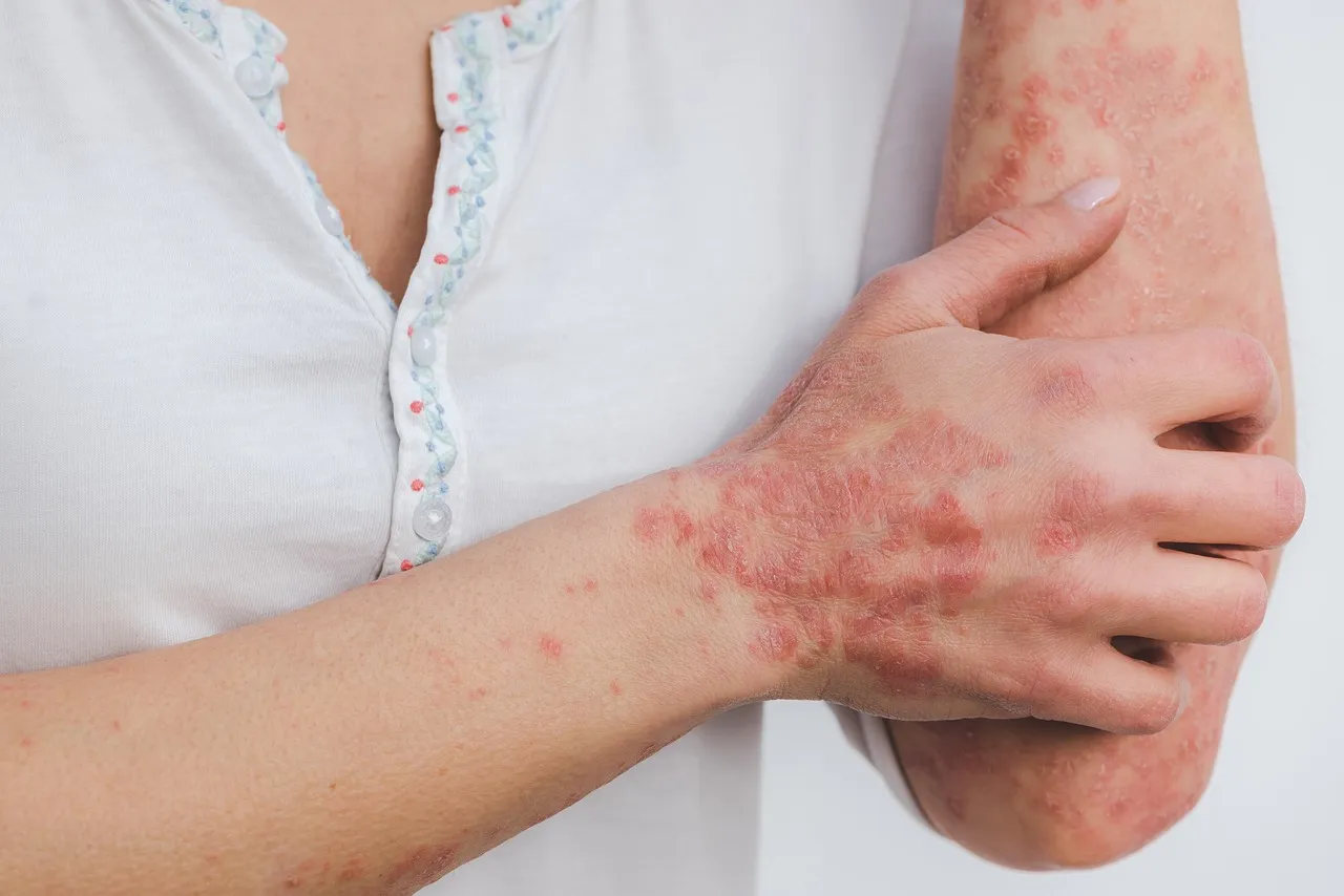 Apa Itu Psoriasis? Kenali Gejala dan Penyebabnya